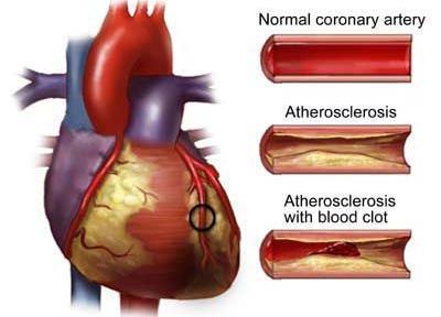 7 Coronary artery blockage can result from: Coronary atherosclerosis which is the development of plaques (containing cholesterol and other lipids) that can narrow the artery lumen