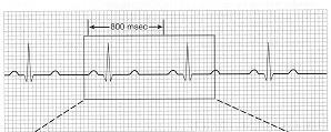 The Electrocardiogram (EKG or ECG) amplifies