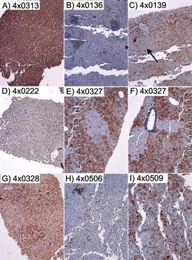 Evidence for Hepatocyte Damage during the Immunotolerant Phase Liver histology not strictly normal in immunotolerant patients Immune pressure on the virus is present, detectable, and