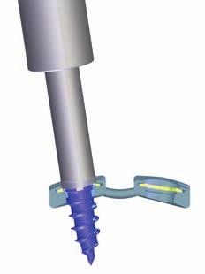 Bone Screw Removal The screw extractor allows for removal of bone screws that have been locked into the plate.