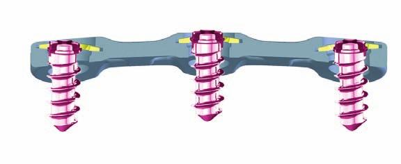 8º 0º 8º Reflex Hybrid variable angle bone screws, which allow sagittal angulation of the screw within a certain range measured from the neutral axis, follow the