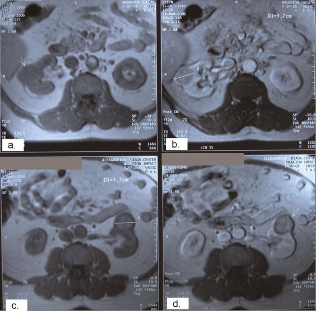 Figure 1. Pre-operative axial magnetic resonance imaging sections showing a 3.7 cm tumor arising from the middle of the right kidney (a, b: post contrast) as well as a 3.
