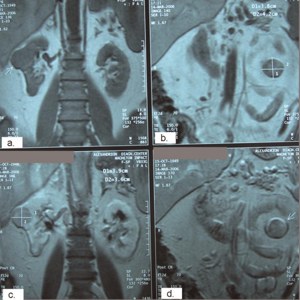 Figure 2. Pre-operative coronal magnetic resonance imaging sections demonstrating the aforementioned right (a, c: post contrast) and left (b, d: post contrast) renal tumors.