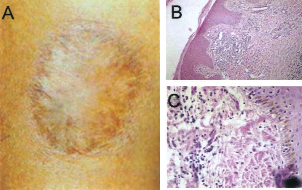 likely mechanism of recurrent lesion involving genotypically and phenotypically identical, sequentially isolated strains [3]. Infection by L. (V.