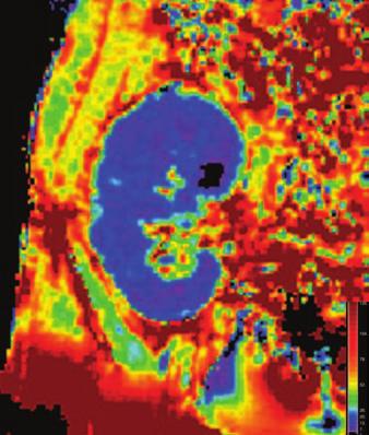 2 Coronal color-coded maps from blood oxygenation level dependent MRI show rates of spin dephasing, denoted as R2*, of normally functioning renal allograft in 41-year-old woman.