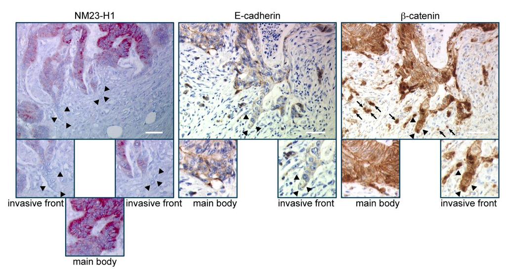 NM23-H1 in colon carcinoma (2) Loss or reduction of NM23-H1 at the