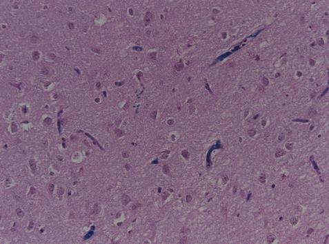 sclerosis, with luxol fast blue stain for myelin.