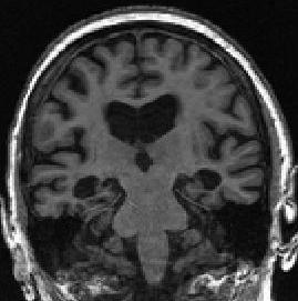 temporal atrophy on MRI (right).