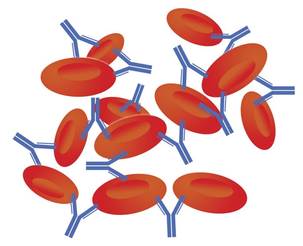 Incompatible Blood Causes an Immune reaction Donor blood antigens recognized as foreign Donor blood is marked by antibodies and clumps (agglutination) Donor