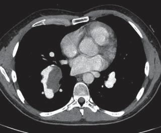 b) At the same time, the computed tomodensitometry scan of the chest revealed a thrombosis of the intermediate branch of the right pulmonary artery (arrow). international normalised ratio of 2.0 