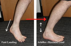 have some swelling. If they can walk at all, it will be with a marked limp. It is very rare that a rupture of the Achilles is partial.