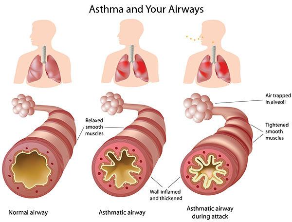 Etiology of Asthma is not clear.