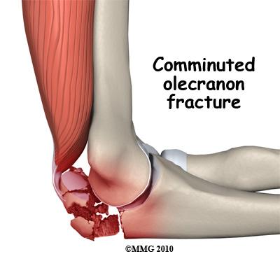 with articular cartilage; it helps form part of the joint surface of the elbow. Signs and Symptoms An olecranon fracture is usually caused by a fall directly on the elbow.