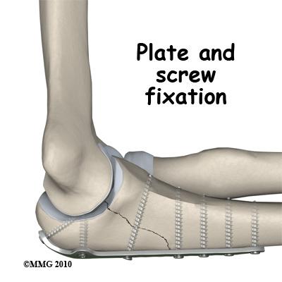 Because the olecranon is superficial (meaning that there is only a thin layer of skin covering the bone) the hardware used to hold the fragments together may be annoying after the fracture has