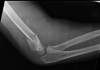 Patient Education Supracondylar Humerus Fractures This is the most common fracture requiring surgery in children age 3-10. It can happen in younger and older kids as well. *Remember!