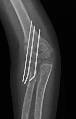 WHAT ABOUT THESE PINS? Patient Education The pins are smooth stainless steel wires which have sharp tips to poke through skin and bone.