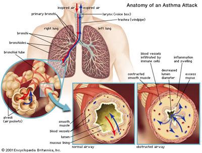 What is Asthma? 2 Definition: a respiratory disorder that causes the lungs to swell, narrow, and produce mucus.