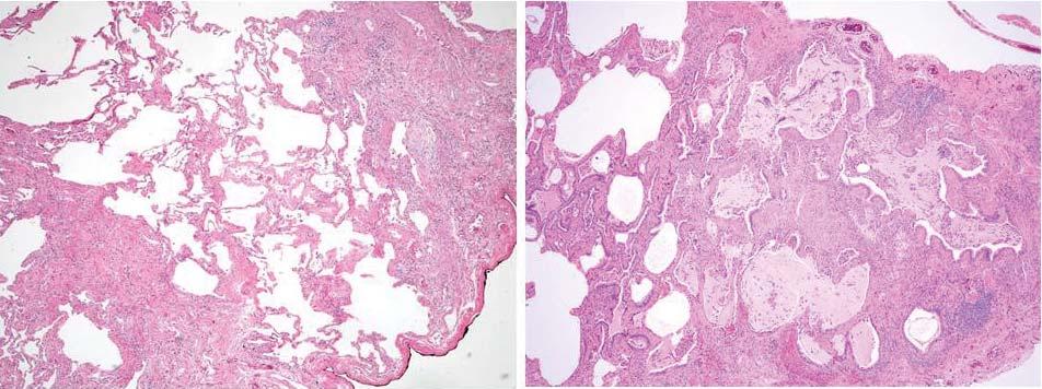a) b) FIGURE 2 a) Open lung biopsy showing fibrotic lung disease with heterogeneous spatial and temporal fibrosis consistent with a usual interstitial pneumonia pattern (haematoxylin and eosin stain,