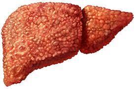 Screening for Alcoholic Liver Disease Alcohol intake should be discussed at primary care visits Blood tests o Assess for