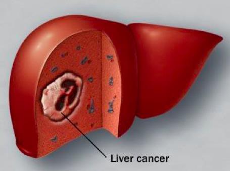 Liver Cancer Treatment Requires Multiple Disciplines Approach: Oncology, Surgery, Radiology, Hepatology