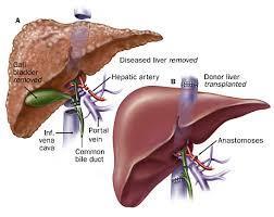 Liver Transplantation Surgical removal of a healthy liver from one person for placement into another person to