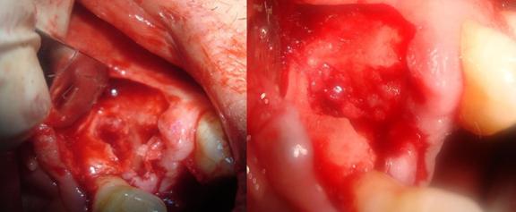 T-lymphocytes. We can take the graft from multiple areas inside or outside the mouth.