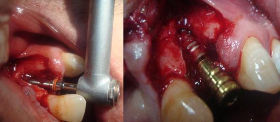 135 Figure 4: Implant