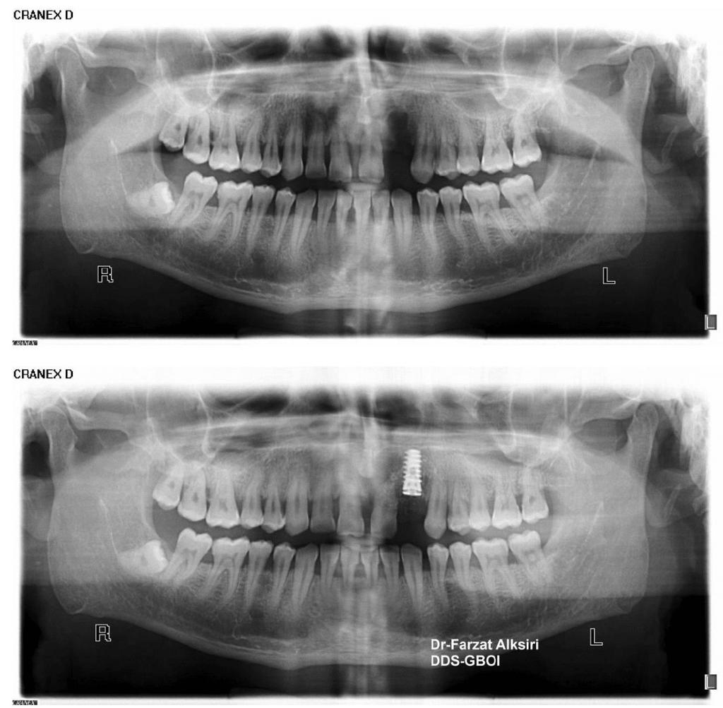 Study Cases: Ride Augmentation Bone by Grafting and PRP/Preparation for Dental Implants Placement 136 Figure 6: Implantation X-Ray.