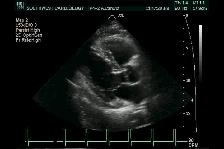 Normal trileaflet aortic