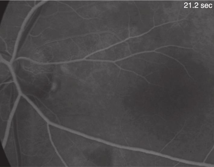 4 Case Reports in Ophthalmological Medicine Figure 3: Fluorescein angiography showing delay of cilioretinal artery filling and a relative delay of the inferior branch retinal arteriole.