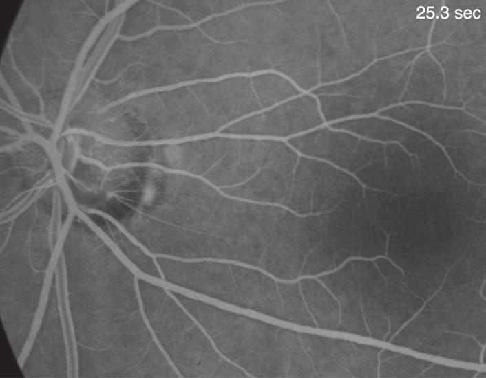 Discussion Usually patients with congenital optic pits may remain asymptomatic until complicated by serous macular schisis and detachment in their s or 40s [4].