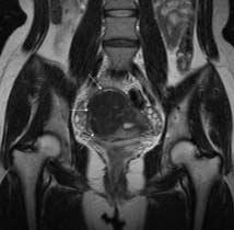 Jin Young Jung, et al : Practical Application of a Coronal MR Image during a Uterine Fibroid Embolization (UFE) purpose of this study is to determine whether either fluoroscopic or single shot images
