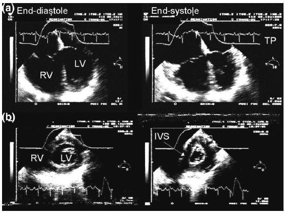 Findings present in diastole and systole and