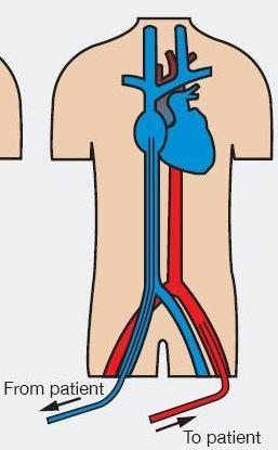 Veno-Arterial ECLS Supports circulation