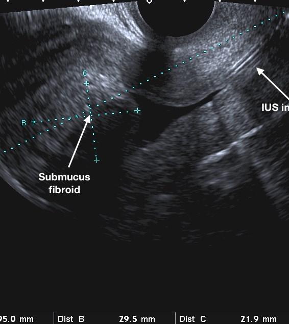 Transvaginal ultrasound Submucous fibroid (distorting endometrial cavity) Heavy menstrual bleeding despite
