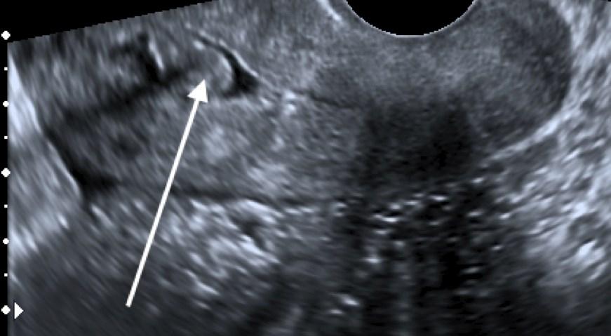 Type 0 fibroid small fibroids may undergo