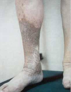 Assessment of the limb } VASCULAR STATUS Doppler and/ or lower limb asessment } Limb shape & size } Haemosiderin staining } Atrophie blanche } Ankle flare } Eczema (& cause varicose, contact,