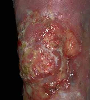 Squamous cell carcinoma Squamous-cell carcinoma (SCC or SqCC) is a cancer of a kind of epithelial cell, the squamous