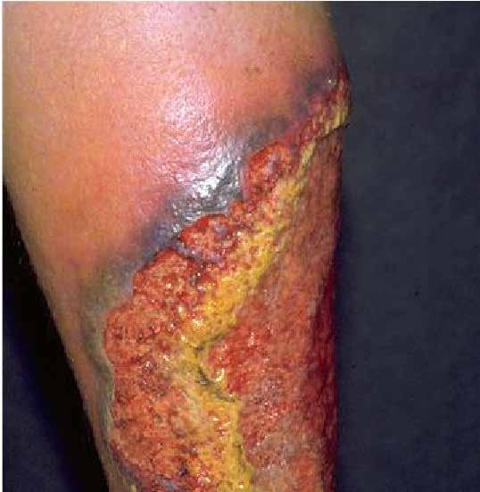 Pyoderma granulosum Though the aetiology is not well understood, the disease is thought to be due to immune system dysfunction, and particularly improper functioning of