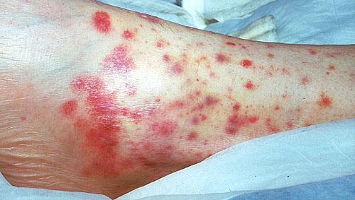 Vasculitis Vasculitis is a group of disorders that destroy
