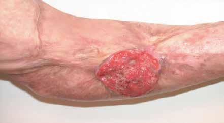 Marjolin's ulcer Refers to an aggressive ulcerating squamous cell carcinoma presenting in an area of previously traumatised, chronically inflamed, or scarred