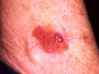 Bowens disease Bowen's disease is a very early form of squamous cell skin