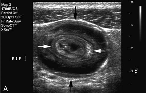 Caused by a portion of the bowel telescoping into another segment of the bowel Most common cause of intestinal obstruction in Peds Rare before 3 mos of age Commonly see following GI illness thought