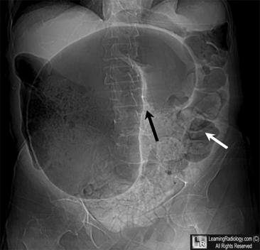 Air contrast enema (air insufflation) as preformed by Radiologist or Surgeon Malrotation & Volvulus Volvulus is a life threatening complication of malrotation Barium enema has higher risk associated