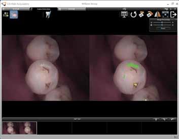 Specular reflection removed images display tooth surfaces in complete detail, allowing clear assessment of tooth surface condition and facilitating caries examination.
