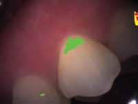 Exclusive FIRE technology Once a potential incipient lesion has been identified during video screening, the practitioner can capture areas of interest on still images for further analysis of the