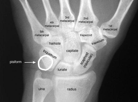 Carpal bones Form wrist Two rows with four bones each Proximal row Scaphoid (navicular) Lunate
