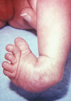 CHAPTER 8 THE APPENDICULAR SKELETON 323 Appendicular System: Congenital Clubfoot Clubfoot, also known as talipes, is a congenital (present at birth) disorder of unknown cause and is the most common
