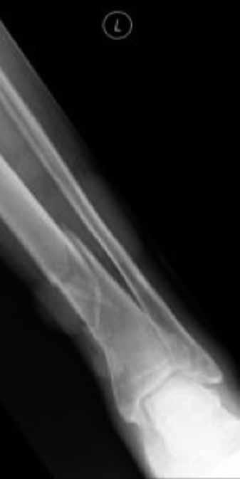 THE SOUTH AFRICAN RADIOGRAPHER volume 51 number 2 NOVEMBER 2013 Figure 1a Figure 1b and below the injury in the lower leg [7]. This also applies to the forearm.