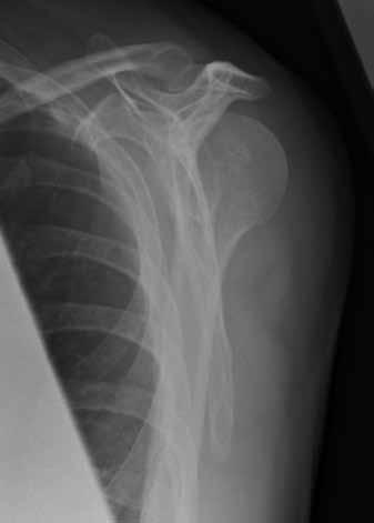 Figure 2b demonstrates an ACJ dislocation. Shoulder dislocations are described by the position of the humeral head with respect of the glenoid [7].